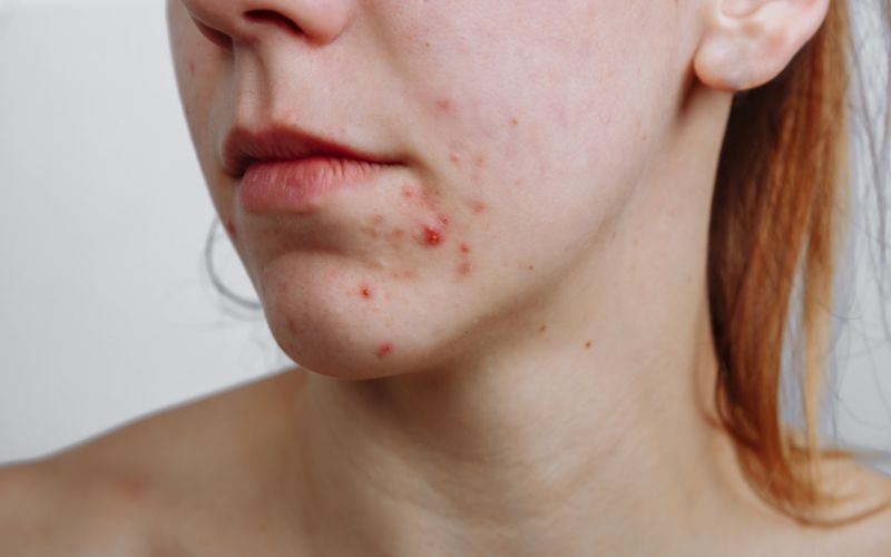 Girl with pimples