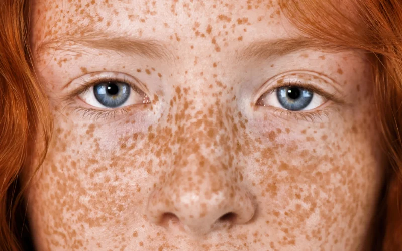 photo of freckled skin